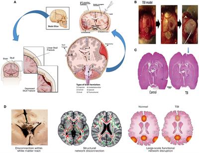 Mesenchymal Stem Cells in the Treatment of Traumatic Brain Injury